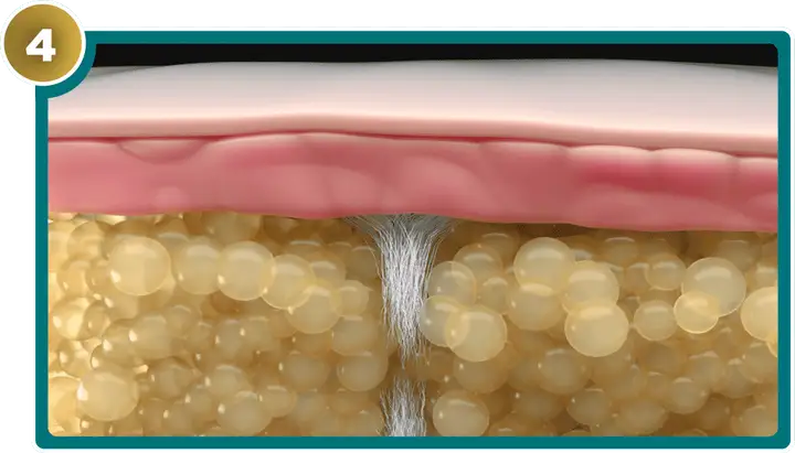 QWO collagenase destroys fibrous septa in cellulite