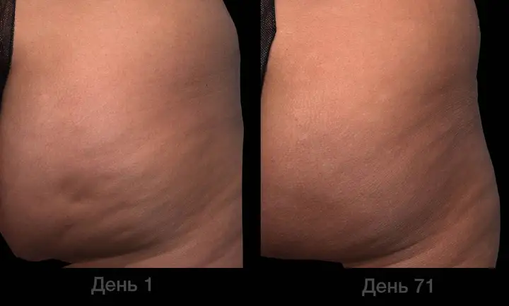 QWO cellulite before and after