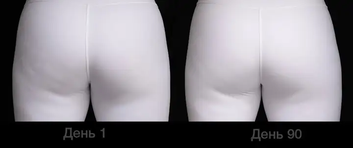 QWO cellulite before and after injections