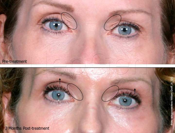 Plasma eyelid rejuvenation