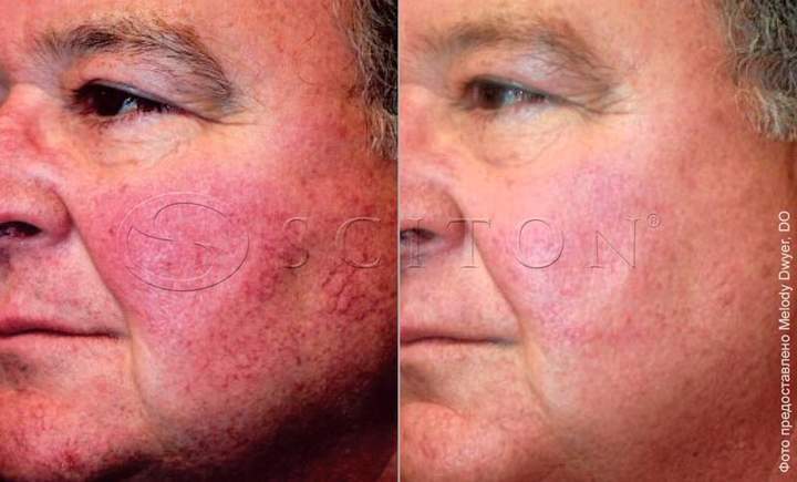 Cuperose on cheeks before and after BBL treatment