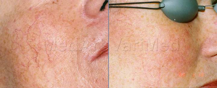 Cuperosis treatment on cheeks using VariMed laser