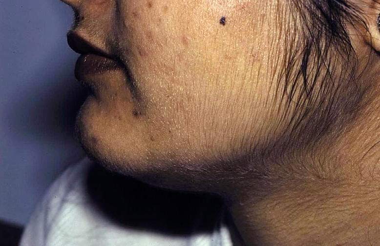 hirsutism - facial hair of a woman