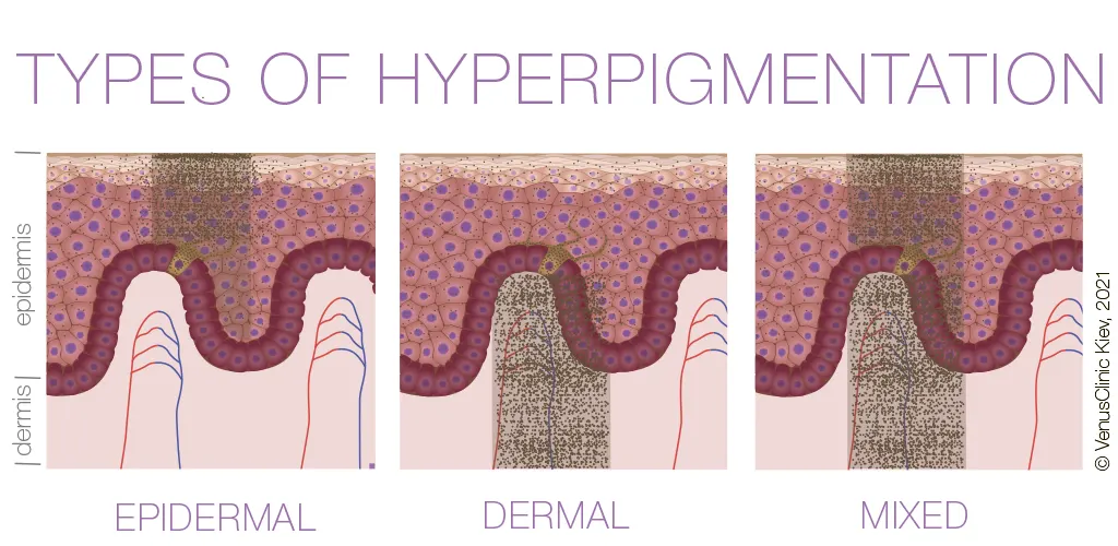 infographics, types of skin hyperpigmentation