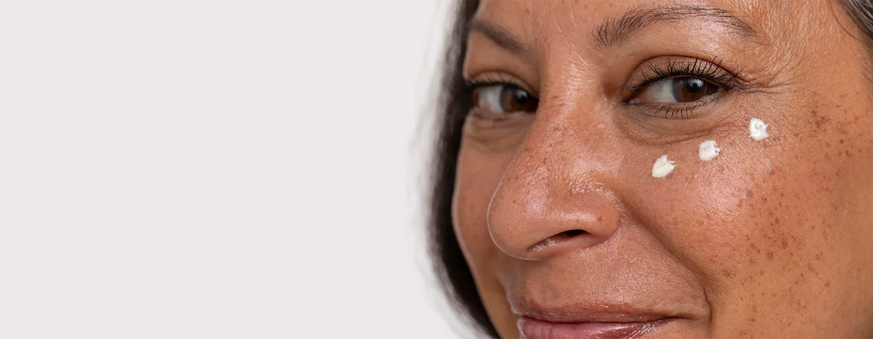 woman with facial hyperpigmentation