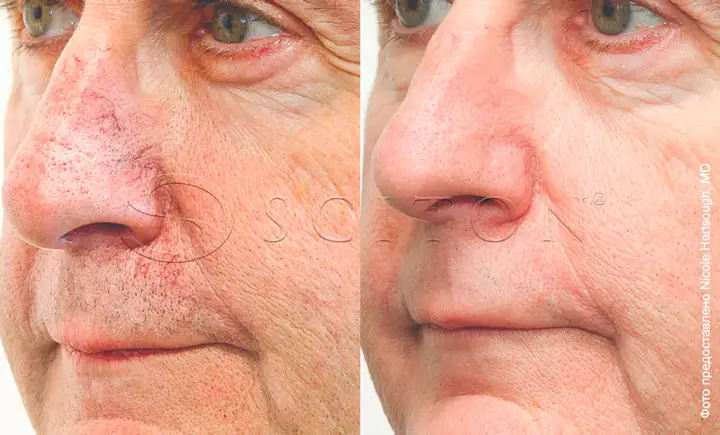 BBL vascular treatment