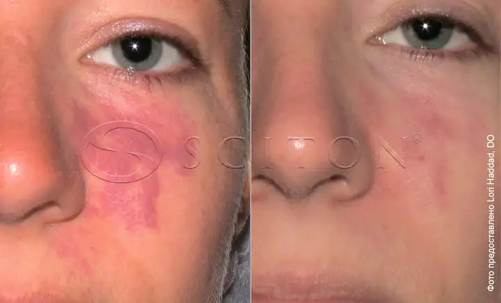 Port wine stain before and after photos