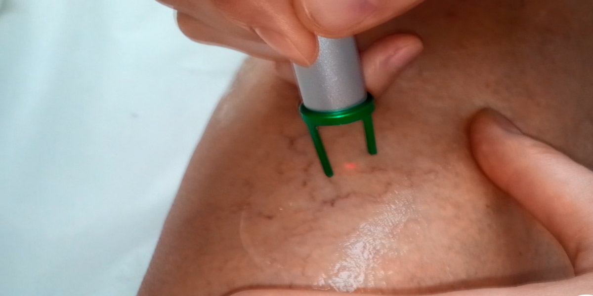 Vascular removal using laser VariMed in Venus Clinic, Kiev