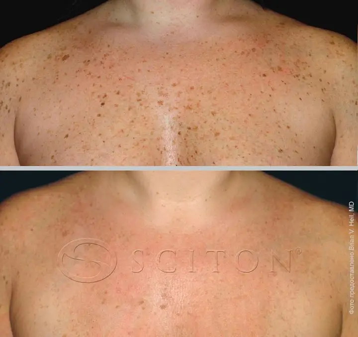 Pigmentation neckline before and after photos