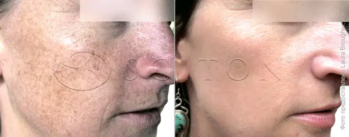 Pigmented spots on the cheeks