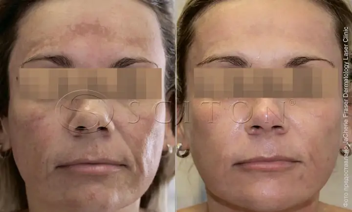 Pigmented spots on the face