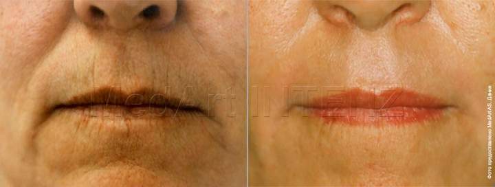 laser resurfacing, wrinkles around the mouth