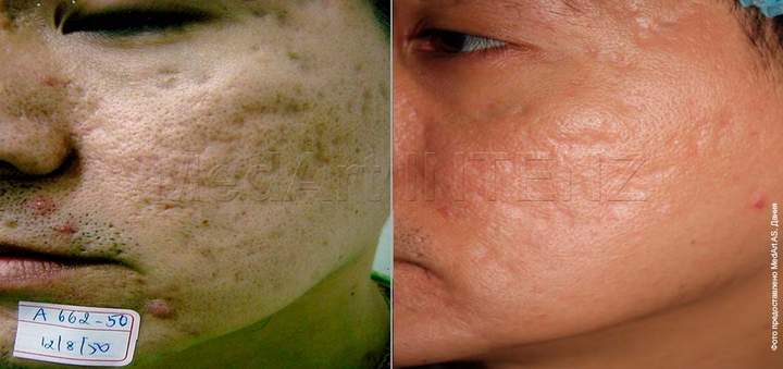 Acne scar laser resurfacing with CO₂ laser Intenz