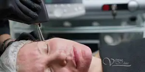 Face laser resurfacing