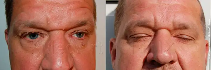 Papillomas on the face and eyelids