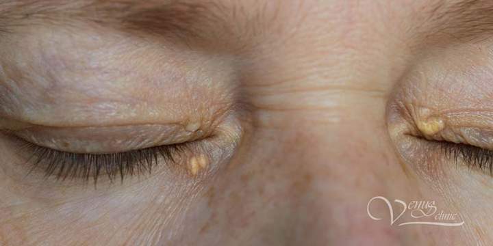 Xanthelasma of the eyelids