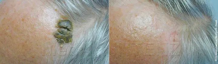 Seborrheic keratosis
