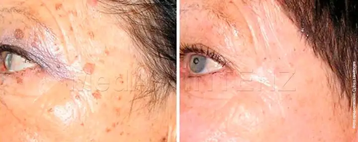 Multiple facial keratomas 