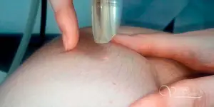Laser keratoma removal
