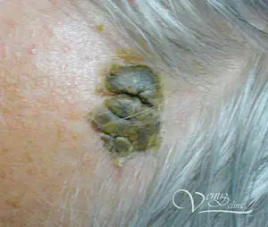 Seborrheic keratosis