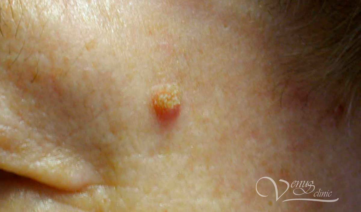 Papilloma on the face