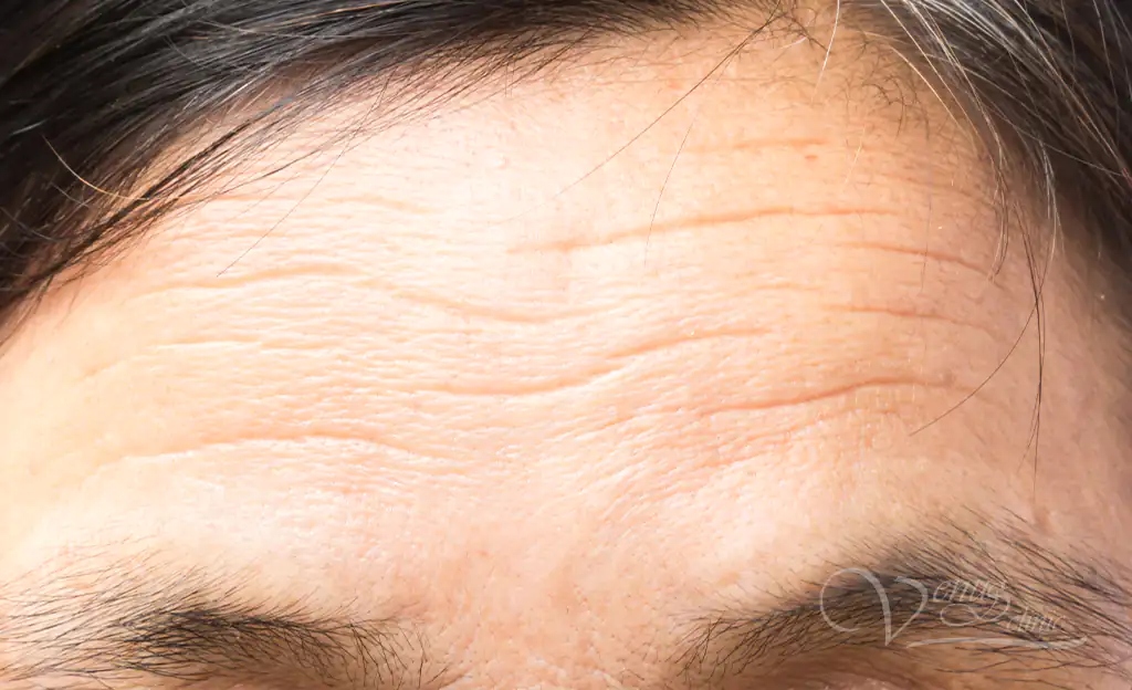  Static forehead wrinkles 