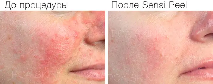  SensiPeel peeling for sensitive skin results.