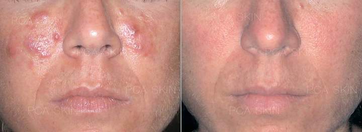 Peeling Jessner for acne, face before and after