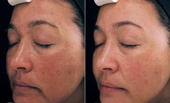 Retinoic peeling before and after photos