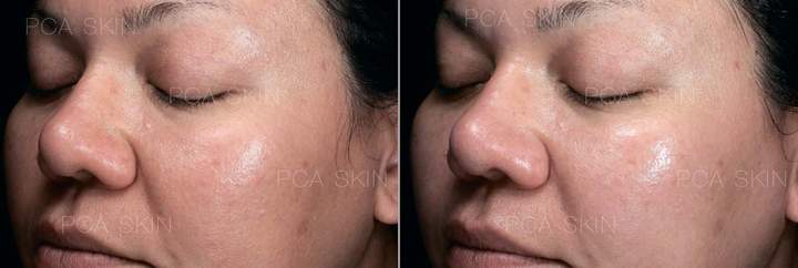 Enzyme peeling photo before and after