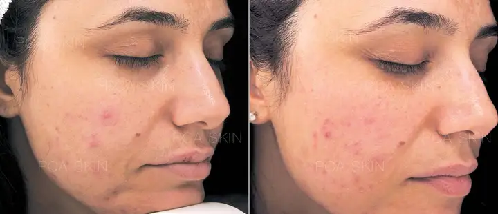 Acne Facials treatment