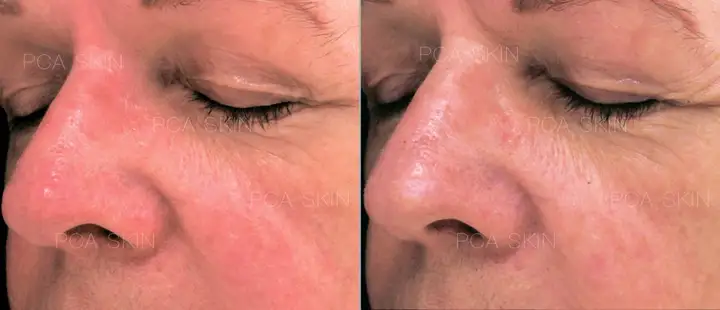 Facials treatment for sensitive skin Therapeutic Oat Milk mask PCA Skin