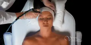 Acne - hydro peeling facial treatment