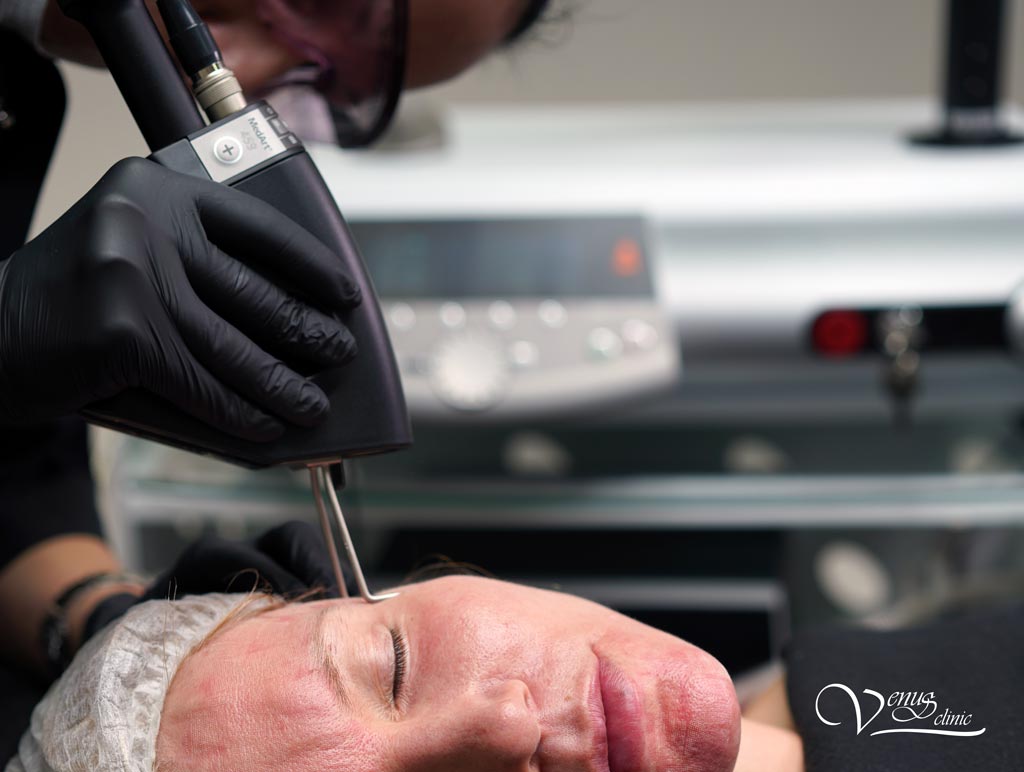 лицо девушки, руки врача, сканер CO2 лазера, проводится процедура лазерной шлифовки