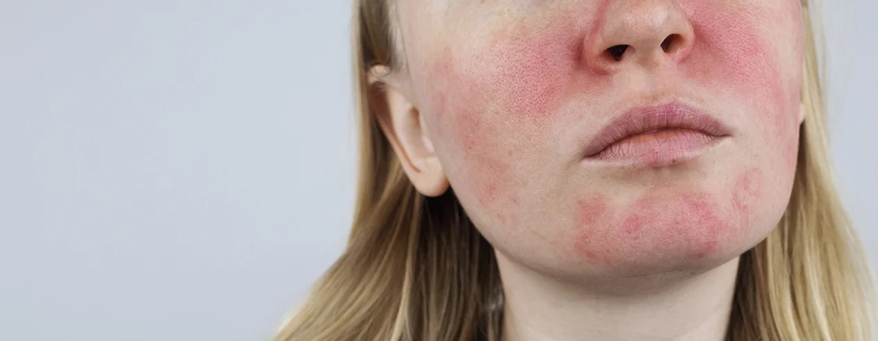 розацеа на обличчі у дівчини