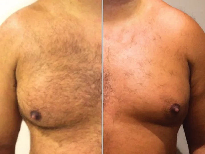 Результати лазерної епіляції чоловічих грудей до і після - Venus Clinic Київ