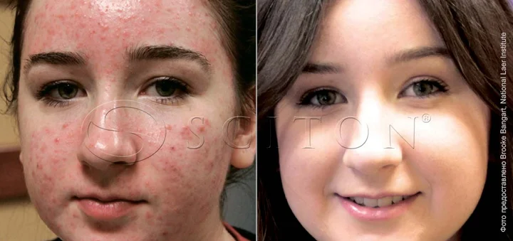 Акне особа дівчина