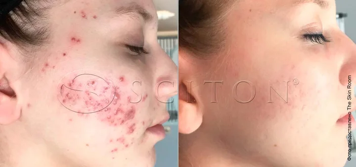 Акне молода дівчина