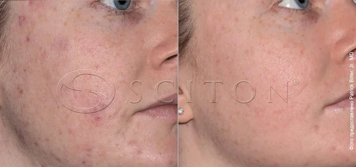 Акне тарда на щоках