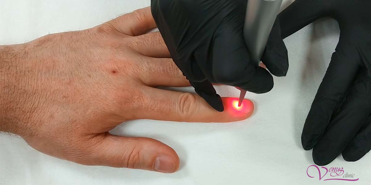 Лазерне лікування грибка нігтів