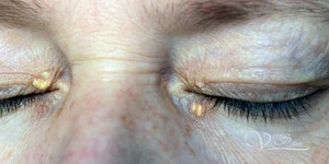 Ксантелазма повіки