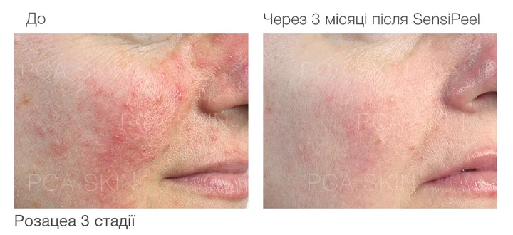 SensiPeel пілінг для чутливої шкіри результати.