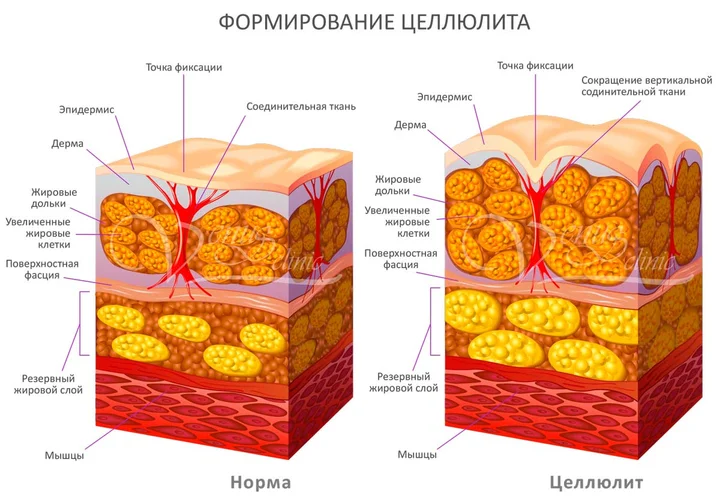 Чому з'являється целюліт, анатомія