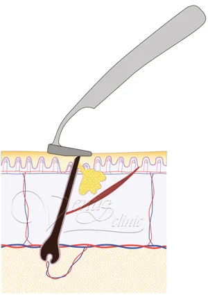 Вросший волос, бритье станком