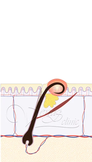 Врослий волос - запалення в шкірі