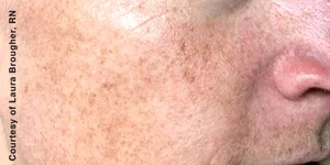 Фотостаріння