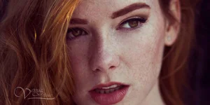 Фотоомоложение лица, девушка веснушки