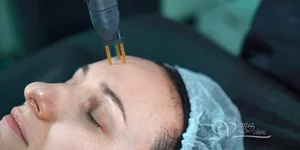 Пациент, процедура, омоложение азотной плазмой