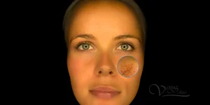 Купероз на лице