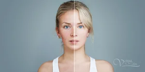 Купероз на лице девушка